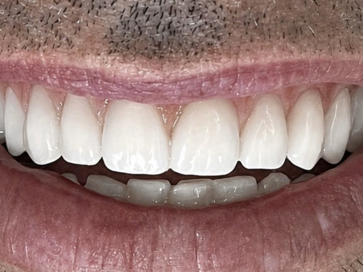 O mesmo sorriso depois do clareamento com lentes de contato dental
